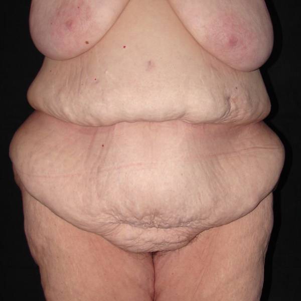 before body lift front view female patient case 4314