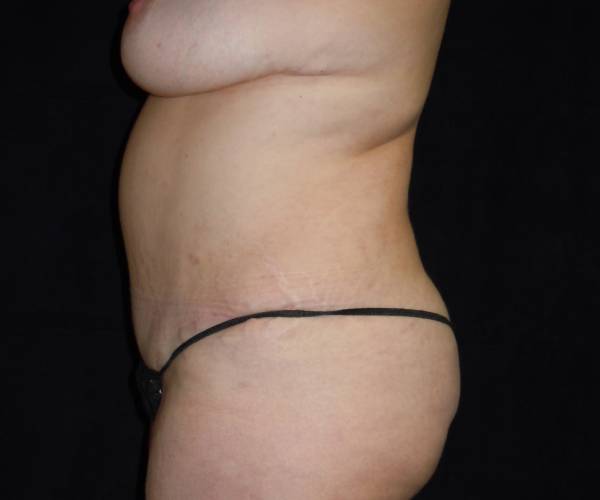 after tummy tuck left side view female patient case 4324