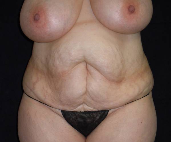 before tummy tuck front view female patient case 4324