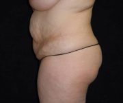 before tummy tuck left side view female patient case 4324