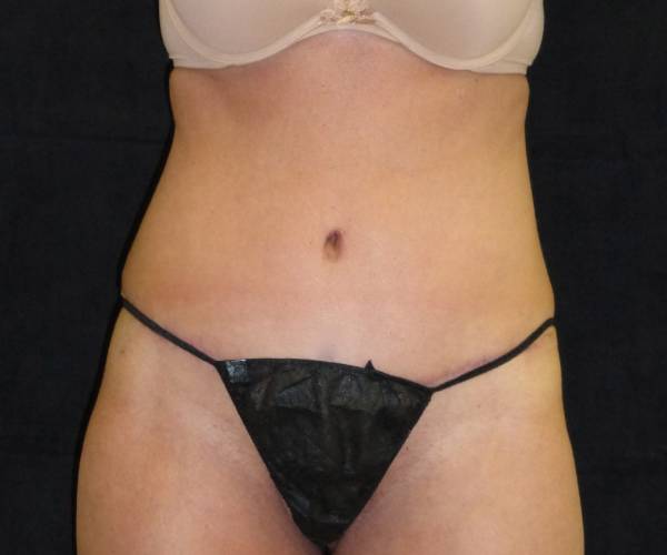 after tummy tuck front view female patient case 4329