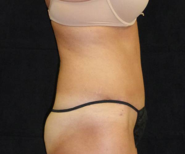 after tummy tuck right side view female patient case 4329