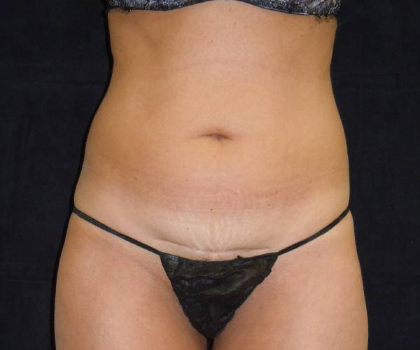 before tummy tuck front view female patient case 4329