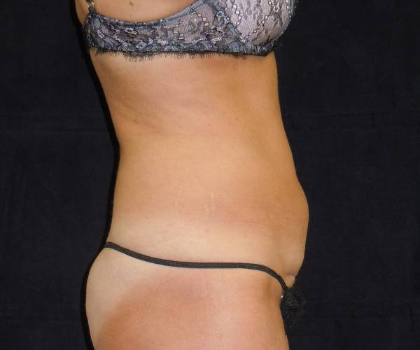 before tummy tuck right side view female patient case 4329