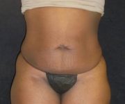 before tummy tuck front view female patient case 4334
