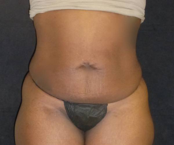 before tummy tuck front view female patient case 4334