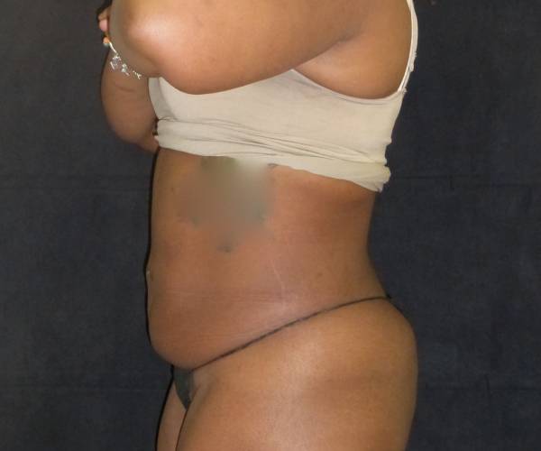 before tummy tuck left side view female patient case 4334