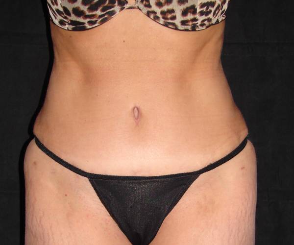 after tummy tuck front view female patient case 4339