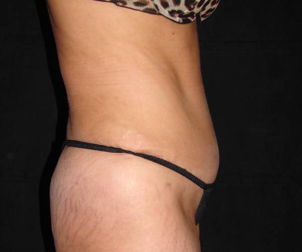 after tummy tuck right side view female patient case 4339