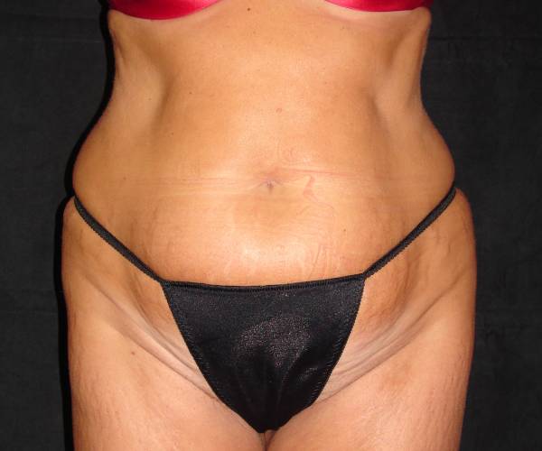 before tummy tuck front view female patient case 4339