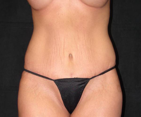 after tummy tuck front view female patient case 4344
