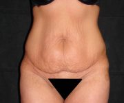 before tummy tuck front view female patient case 4344