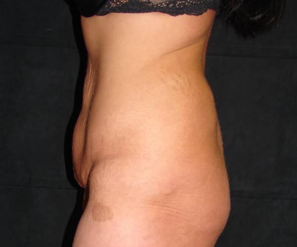 before tummy tuck left side view female patient case 4344