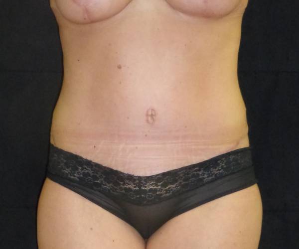 after tummy tuck front view female patient case 4350