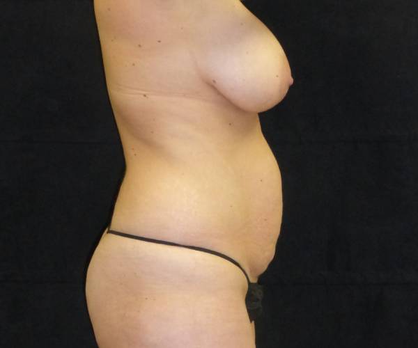 before tummy tuck right side view female patient case 4350