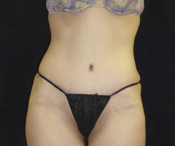 after tummy tuck front view female patient case 4356