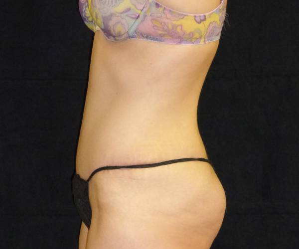 after tummy tuck left side view female patient case 4356