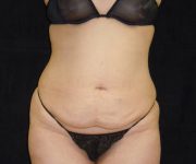 before tummy tuck front view female patient case 4356