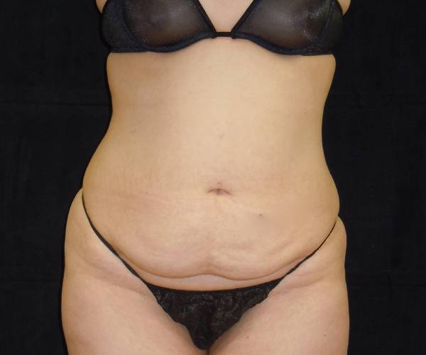 before tummy tuck front view female patient case 4356
