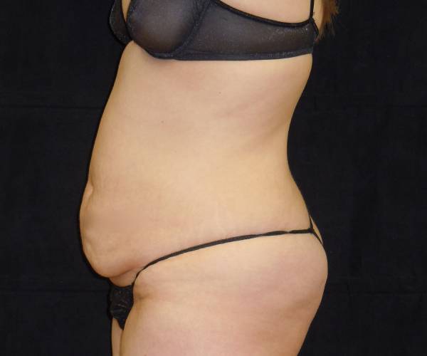 before tummy tuck left side view female patient case 4356