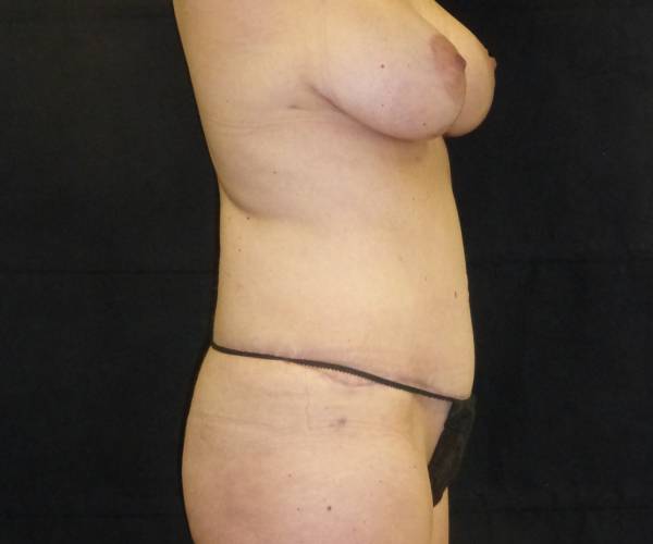 after tummy tuck right side view female patient case 4361