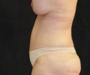 after tummy tuck left side view female patient case 4371