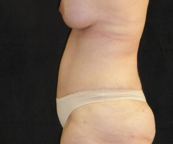 after tummy tuck left side view female patient case 4371
