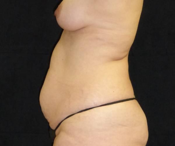 before tummy tuck left side view female patient case 4371