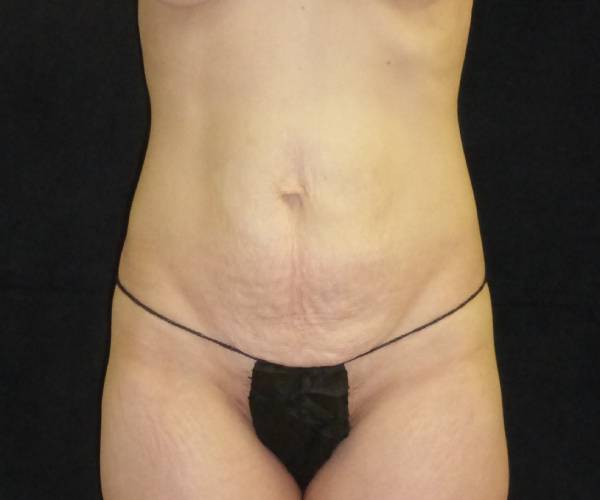 before tummy tuck front view female patient case 4376