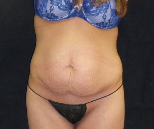 before tummy tuck front view female patient case 4381