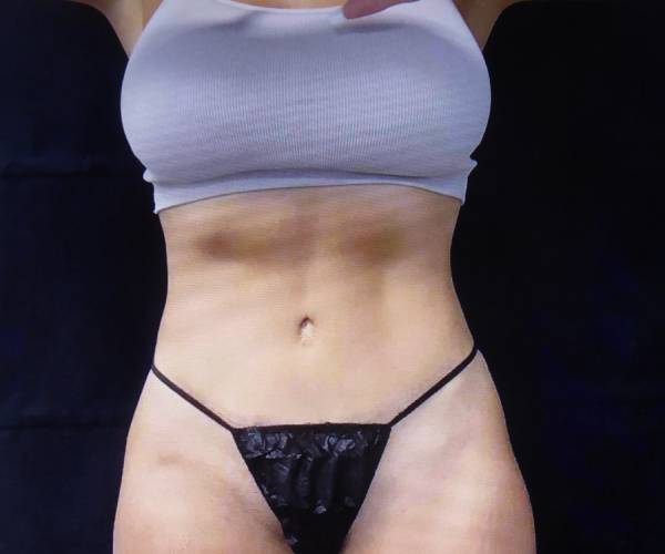 after tummy tuck front view female patient case 4391