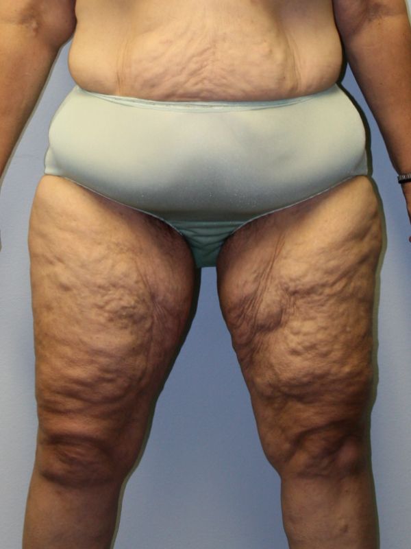 before thigh lift front view female patient case 4995