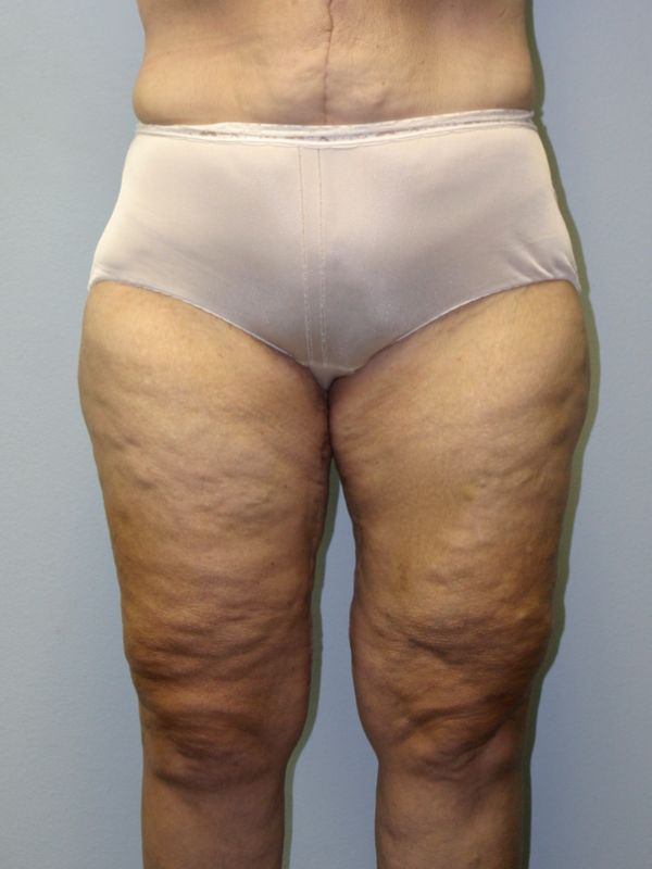 after thigh lift front view female patient case 4995
