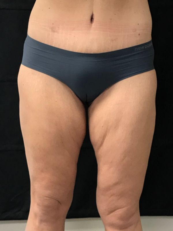 before thigh lift front view female patient case 5022
