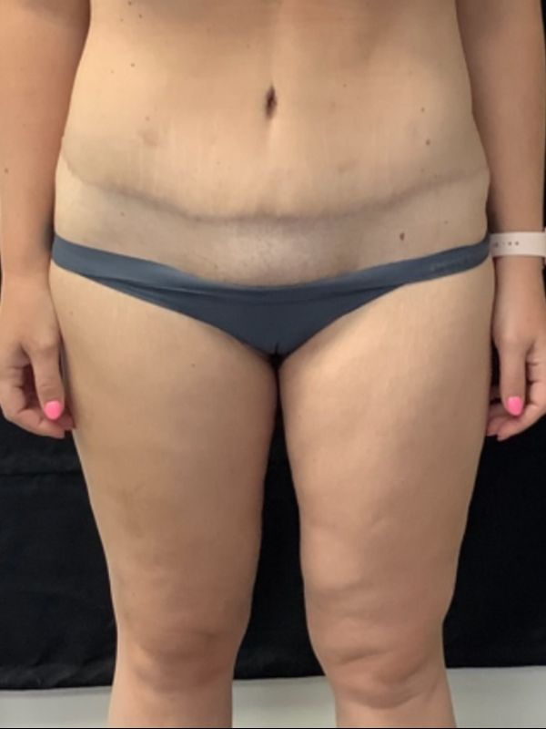 after thigh lift front view female patient case 5022