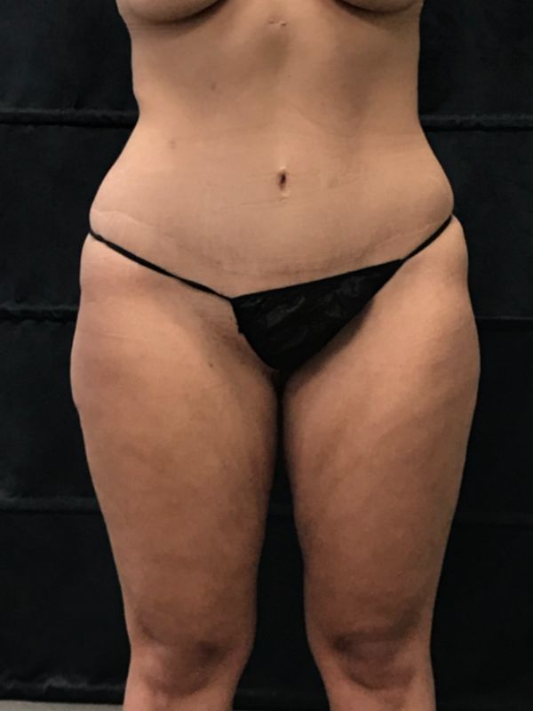 before thigh lift front view female patient case 5025