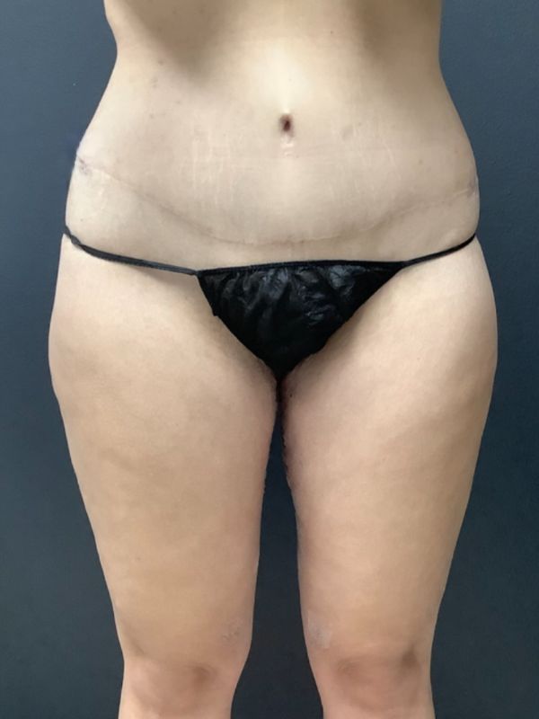 after thigh lift front view female patient case 5025